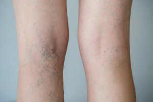 Metode de tratament folcloric picioarele varicoase