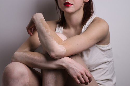 Vitiligo poate afecta brațele