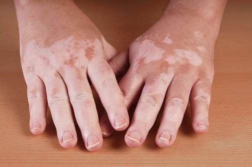 Remedii naturiste pentru vitiligo