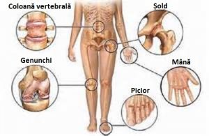5 remedii naturale pentru durerile articulare