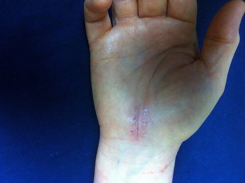 Sindromul de tunel carpian afectează mâinile