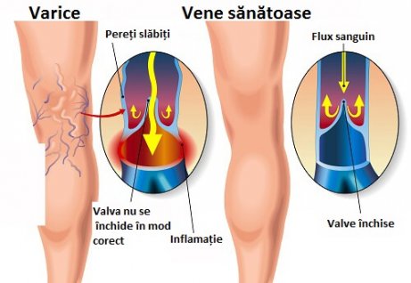 picioarele stoarce de la varicoză vindecare varicose venic