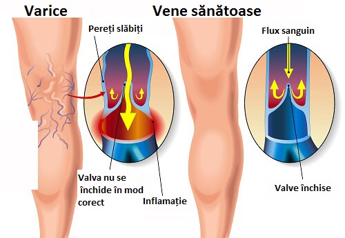 îngrijirea piciorului dupa operaie varicoza