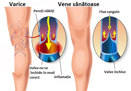 Nevoia de a folosi un tratament pentru varice