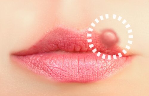 10 tratamente naturale pentru herpesul oral