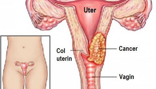 cancerul uterin cu virusul papiloma uman