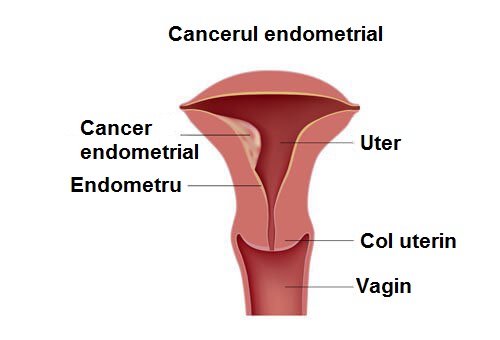 Cancerul endometrial la femei