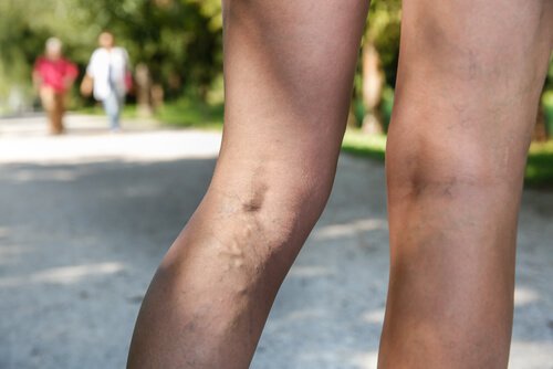 varice vindecate pe picioare colanii elastice împotriva varicozei varicoase