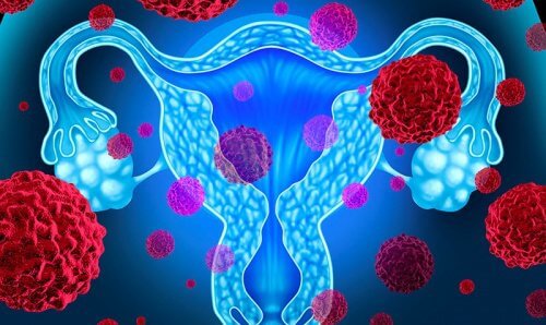 Cancerul endometrial: 5 informații importante