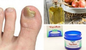 6 remedii naturale pentru ciuperca unghiei