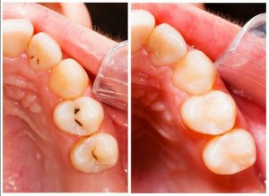 11 trucuri simple pentru a preveni cariile
