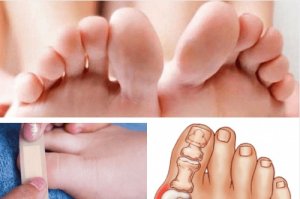 cornuri între tratamentul degetelor de la picioare