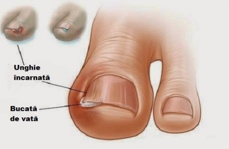 probleme articulare pe degetele de la picioare