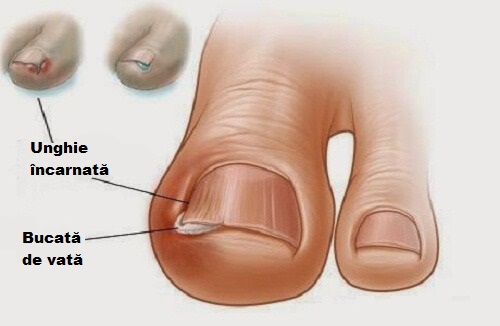 Afecțiuni ale degetelor de la picioare legate de unghii