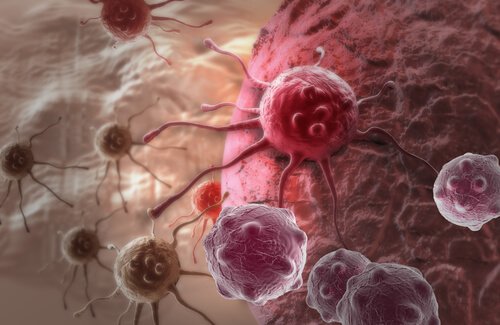 Cancerul tiroidian la femei provoacă tumori