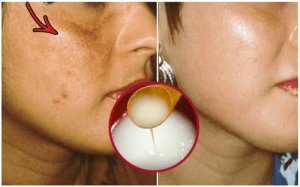 Depigmentarea pielii - Serum pentru albirea pielii - Albirea tenului - Tratament facial