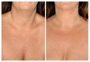 Întinerirea pielii gâtului cu remedii naturale