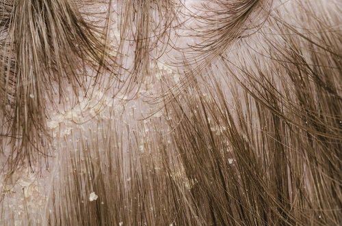 Probleme ce apar și necesită să-ți îngrijești scalpul
