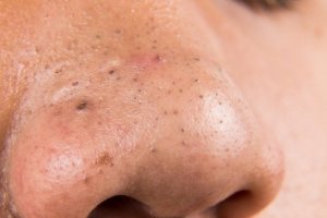 5 remedii naturiste împotriva punctelor negre