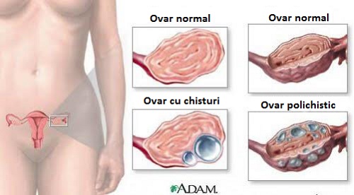 9 informații utile despre chisturi ovariene