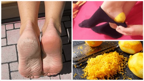 Cum să tratezi o arsură pe picior cu blistere