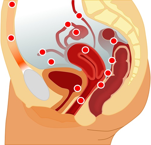 endometrioza Endometrioza