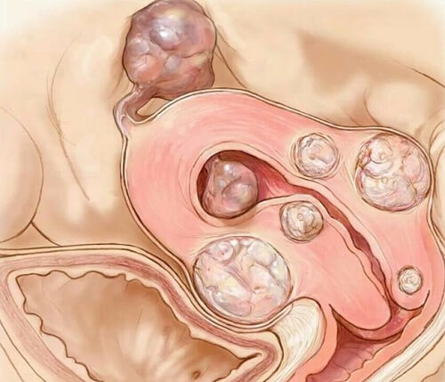 Fibromul uterin și cauzele sale
