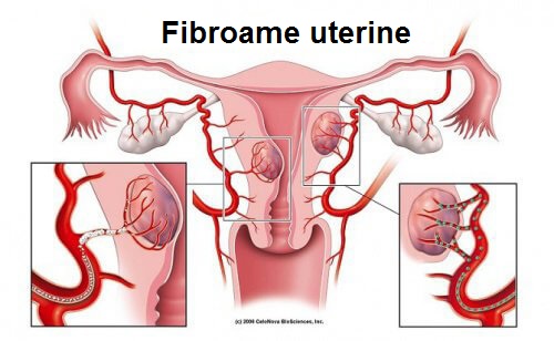 Fibromul uterin: 5 informații importante