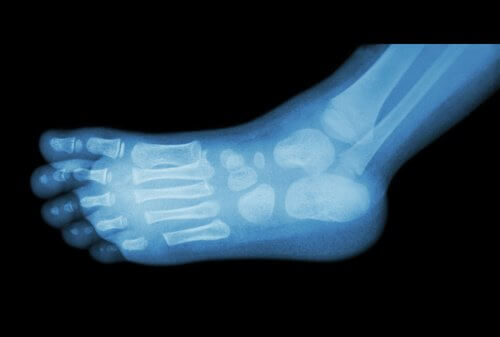 Următoarele metode de prevenție te ajută să eviți pintenii calcaneeni