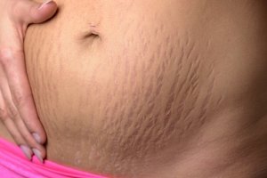 belly varicoză în timpul sarcinii