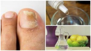 Top 5 remedii pentru ciuperca unghiilor