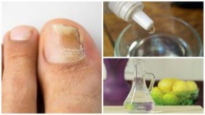 Remediu natural pentru onicomicoză din 3 ingrediente