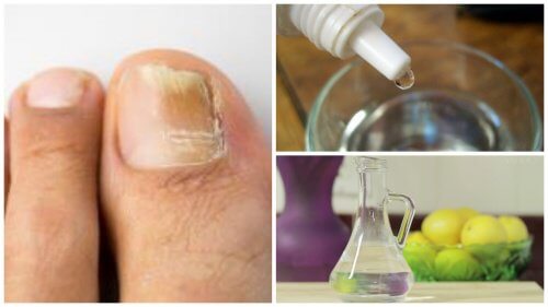 remediu homeopat pentru ciuperca unghiilor