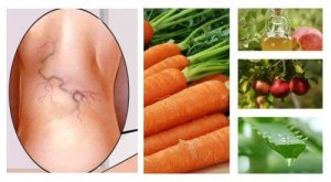 Remediu pentru varice din 3 ingrediente