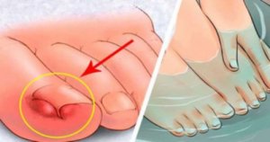Unghiile încarnate: 6 remedii naturale
