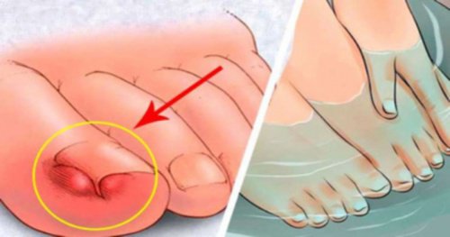 ciuperca unghiilor de la picioare cum să tratezi pantofii ciuperca nu crește unghia