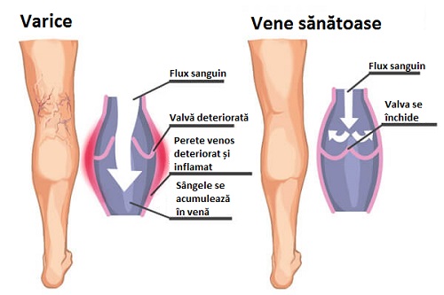 tratamentul venelor venice varicoase pe picioarele de miere exerciții pentru mușchii picioarelor în varicoză