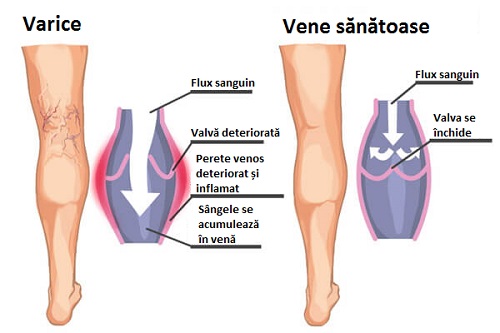 Varicele pot fi însoțite de durere