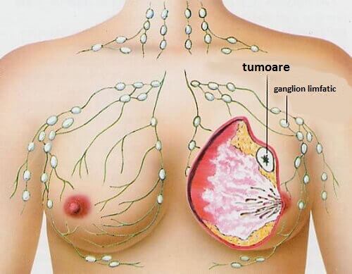 cancerul-de-san-cauze Cancerul de sân poate avea diverse cauze
