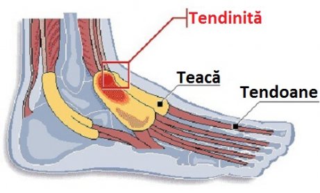 inflamația articulară claviculară a tendoanelor tratamentului periostic)