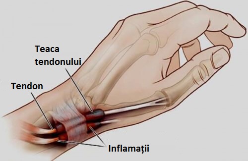 Ce este tenosinovita, inflamația mâinilor și a picioarelor