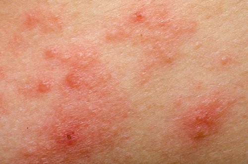 Dermatită de contact