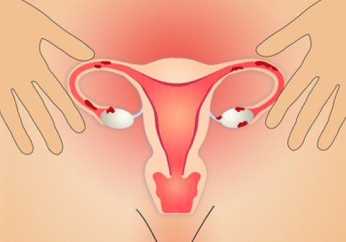 Cheagurile de sânge cauzate de endometrioză