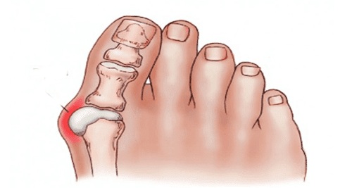inflamația articulațiilor degetului de la picioare)