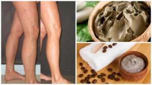 5 remedii naturiste pentru varice