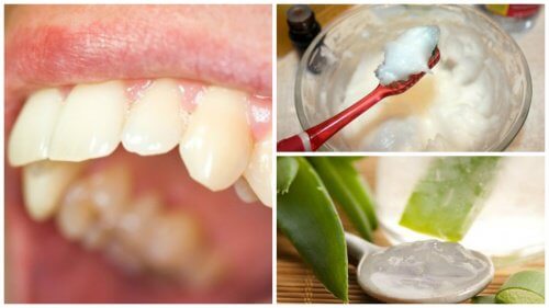 Tartrul dentar: remedii naturale