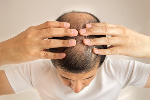 Alopecia poate semnala că ficatul tău este suprasolicitat