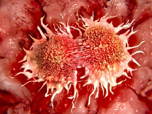 Cancerul de colon trebuie detectat la timp