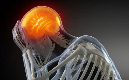 Durerea de cap poate fi provocată și de un atac cerebral