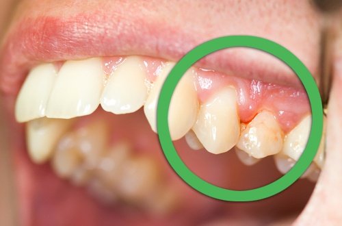 Durerea de dinți poate fi cauzată de gingivită